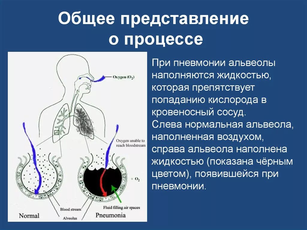 Обогащение легких кислородом. Кислород при пневмонии. Кислород при воспалении легких. Кислород при пневмонии у детей.