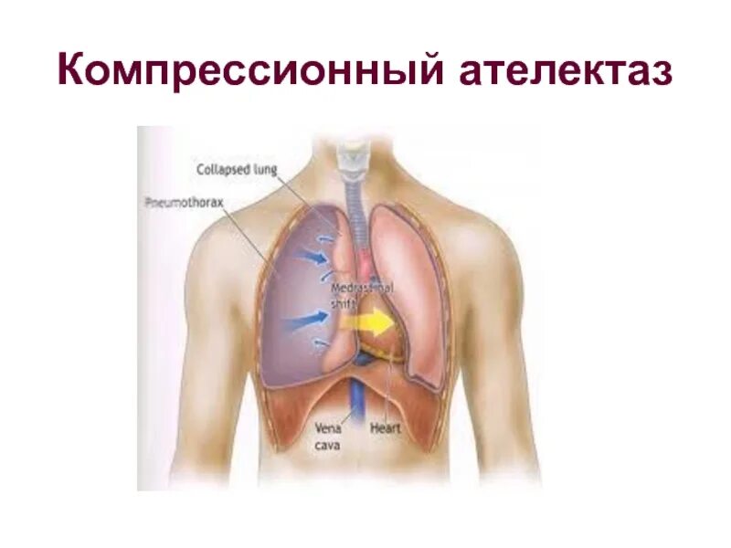 Отличия компрессионного и обтурационного ателектаза. Компрессионный ателектаз. Компрессионный и обтурационный ателектаз. Компрессионный ателектаз легкого