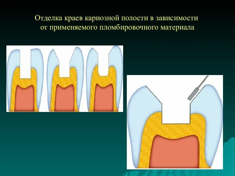 Этап формирования полости. Этапы препарирования кариеса зубов. этапы препарирования раскрытие полости. этапы препарирования полости кариеса. препарирование кариозных полостей.