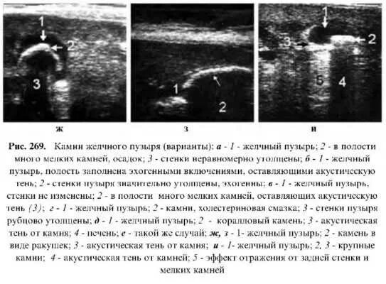 Диффузное утолщение стенок. Уплотнение стенки желчного пузыря 4,4мм. Стенки желчного пузыря утолщены. Стенка желчного пузыря утолщена. Утолщение стенки желчного пузыря на УЗИ.