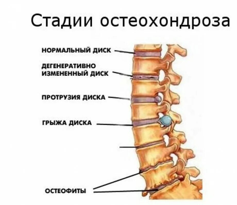 Протрузия дисков позвоночника и грыжа диска. Грыжи и протрузии межпозвонковых дисков. Остеохондроз поясничного отдела периоды. Протрузия дисков позвоночника что это такое.