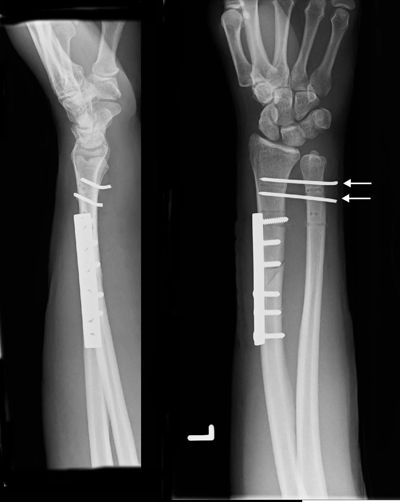 Лучевая трещина. Перелом Галеацци остеосинтез. Перелом Монтеджи остеосинтез. Остеосинтез лучевой кости. Перелом диафиза лучевой кости.