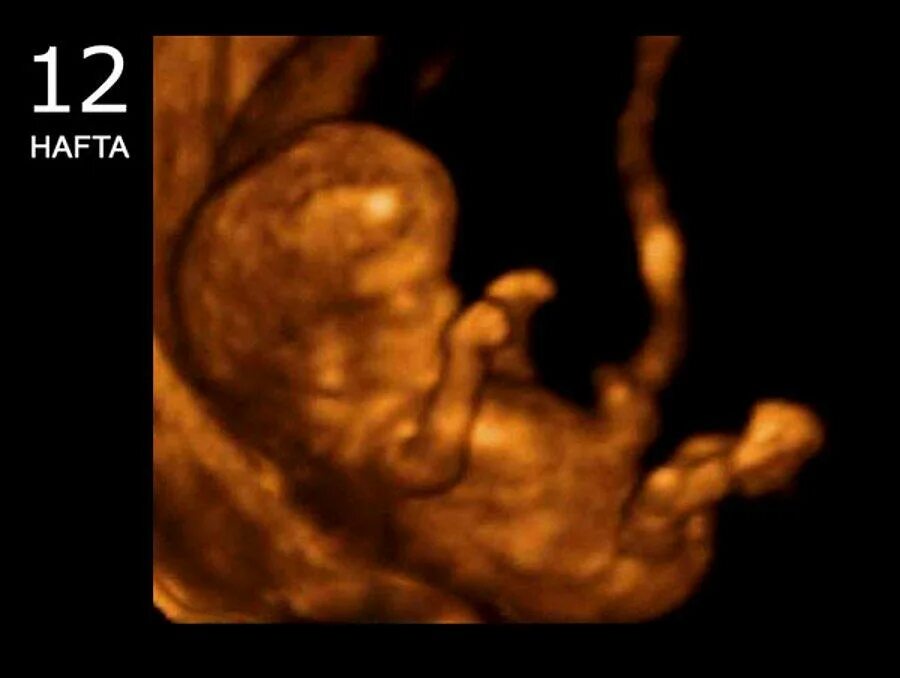 Эмбрион на 12 неделе беременности УЗИ. 3д УЗИ на 12 неделе беременности. Снимок УЗИ на 12 неделе беременности. УЗИ малыша на 12 неделе беременности фото. 12 недель и 1 день