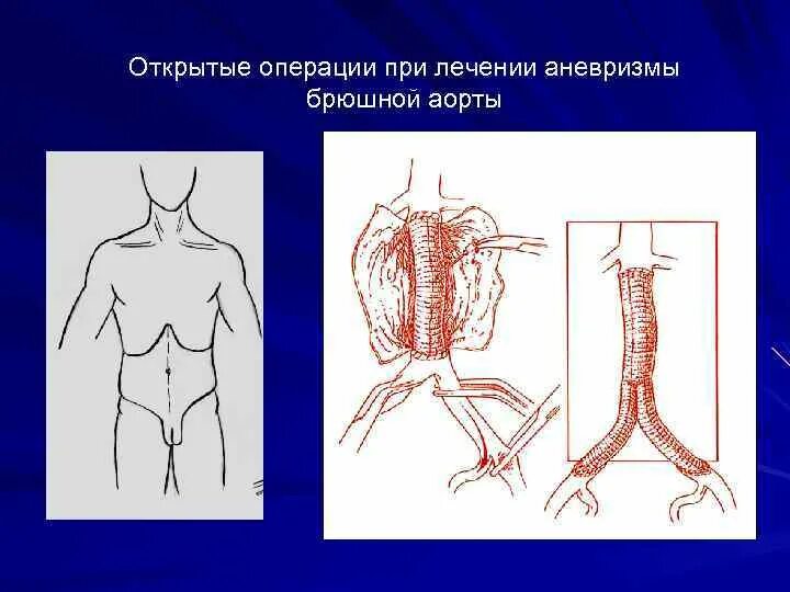 Аорта брюшной полости операция. Веретенообразная аневризма инфраренального отдела брюшной аорты. Веретенообразная аневризма брюшной аорты медикаментозная терапия. Мешковидная аневризма аорты брюшной полости. Фузиформная аневризма инфраренального отдела аорты.