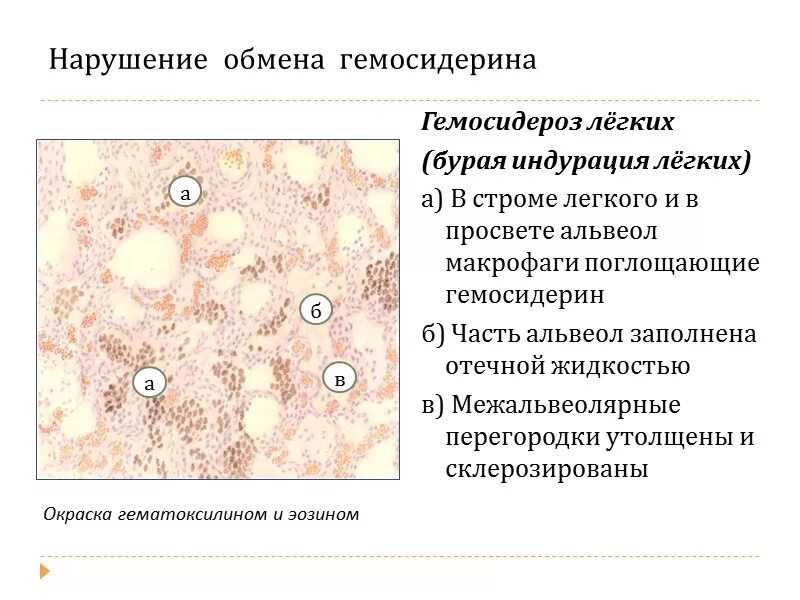 Бурая индурация легких патанатомия. Бурая индурация легкого патоморфология. Бурая индурация легких макропрепарат. Бурая индурация лёгкого микропрепарат. Бурая индурация легких окраска гематоксилином и эозином.