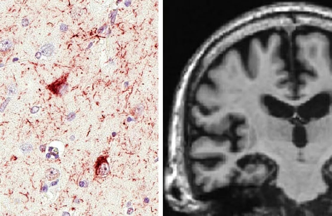 Бляшка в головном мозге. Болезнь Альцгеймера патологическая анатомия. Нейрофибриллярные клубки болезнь Альцгеймера. Нейрофибриллярные клубки при болезни Альцгеймера. Болезнь Альцгеймера томография.
