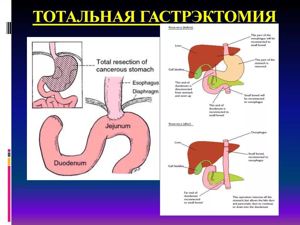 Последствия операции желудка. Гастрэктомия схема операции. Гастрэктомия анастомоз. Гастрэктомия желудка техника операции. Резекция желудка тотальная операция.