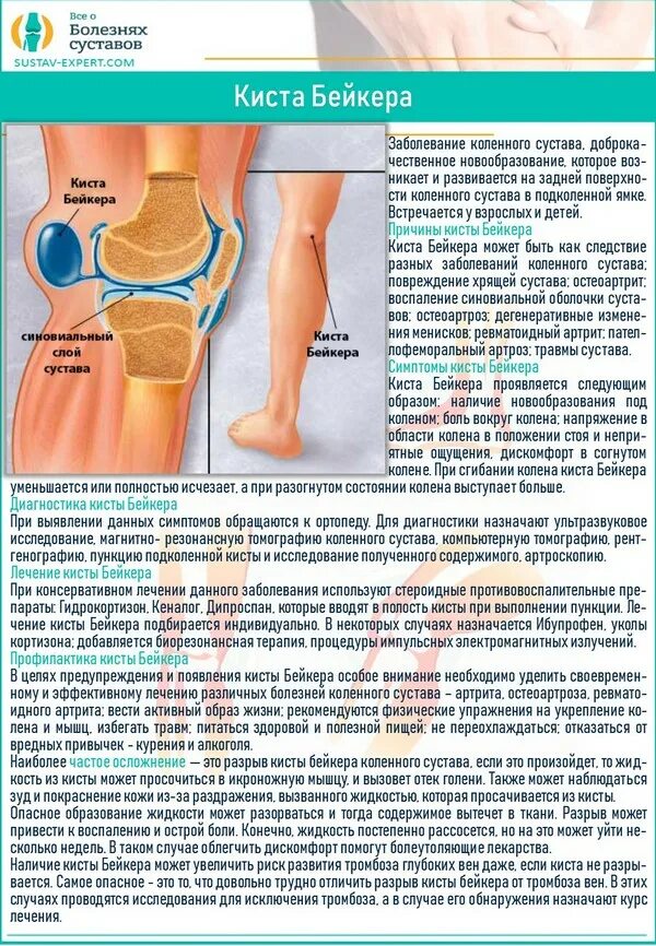 Заболевания суставов обратиться. Ревматоидный коленный сустав: киста Бейкера, сгибательные деформации. Бейкера киста Бейкера коленного сустава.