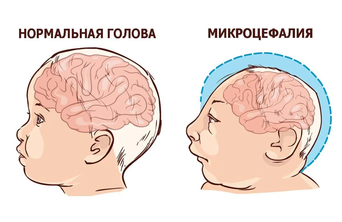 Внутриутробное недоразвитие головного мозга. Микроцефалия врождённый токсоплазмоз. Микроцефалия головного мозга. Микроцефалия окружность головы. Микроцефалия голова ребенка.