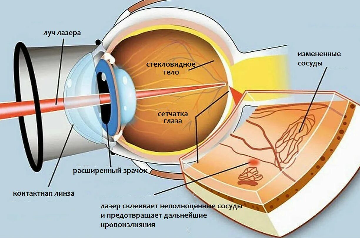 Диабетическая ретинопатия глаз. Воздействие лазерного излучения на глаза.