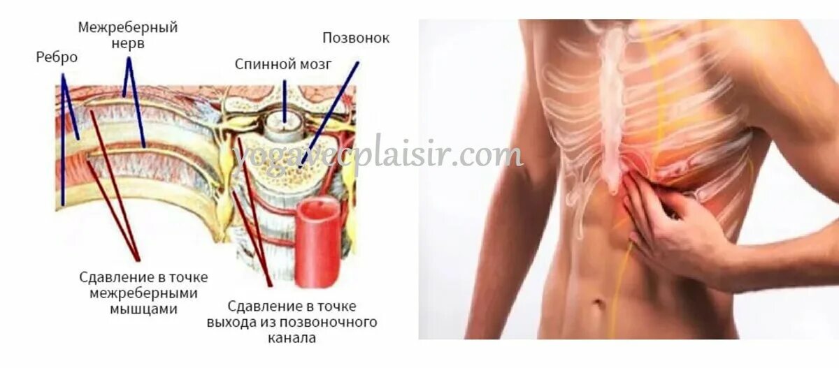 Реберная невралгия. Межреберная невралоги. Межребеберная неврология. Меж ребренная невралгия. Чем снять межреберную невралгию