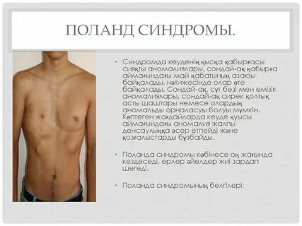 Синдром грудины