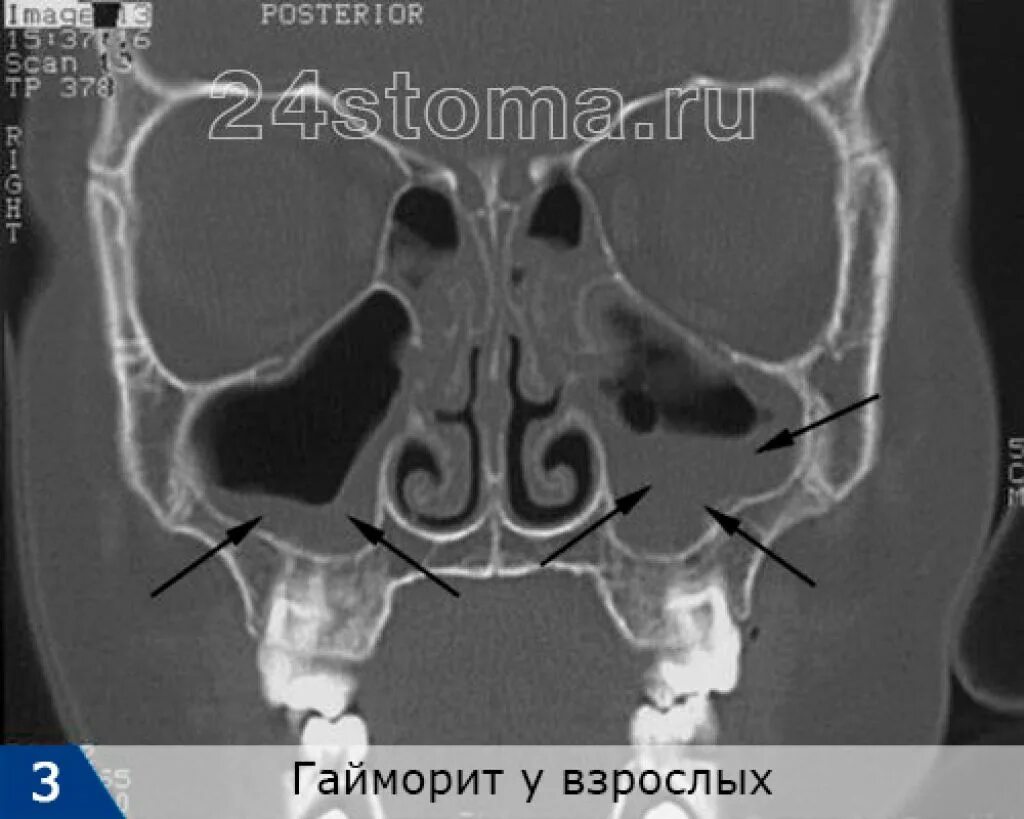 Синусит на кт. Острый верхнечелюстной синусит кт. кт гайморовых пазух с гайморитом. полипозный хронический синусит на кт.