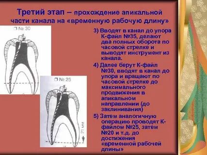 Апикальный упор
