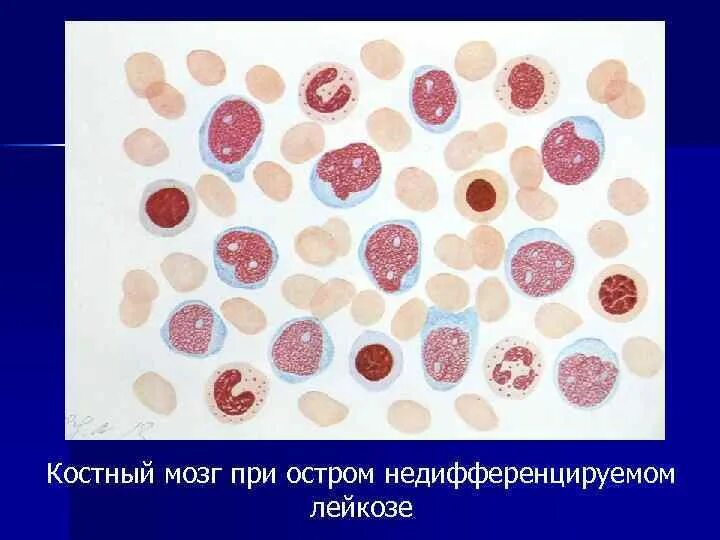 Мозг при остром лейкозе. Острый недифференцированный лейкоз костный мозг. Острый недифференцированный лейкоз картина крови. Острый миелоидный недифференцированный лейкоз. Острый миелобластный лейкоз картина костного мозга.