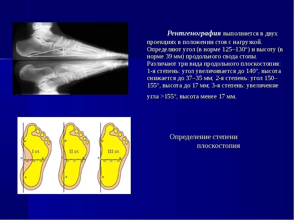 Поперечное 1 степени. Продольное плоскостопие 2 степени рентген описание. Продольное плоскостопие рентген. Продольное плоскостопие норма рентген. Продольное плоскостопие рентген описание.