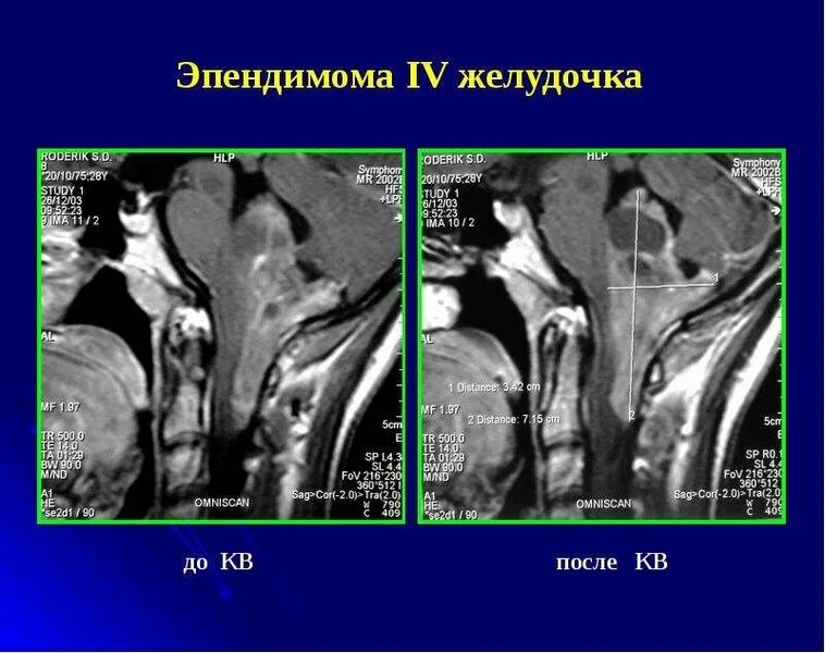 Анапластическая эпендимома гистология. Опухоли 4 желудочка головного мозга мрт. Эпендимома 4 желудочка мрт. Эпендимома 4 желудочка. Опухоль четвертого желудочка головного мозга.