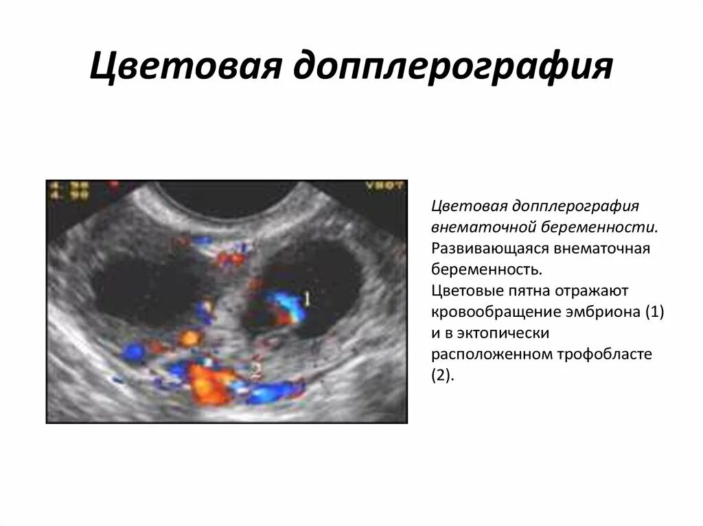 Внематочная беременность на УЗИ. Внематочная беременность в трубе УЗИ. Фото УЗИ внематочной беременности с описанием. Внематочная беременность УЗИ картина. На узи видно внематочную