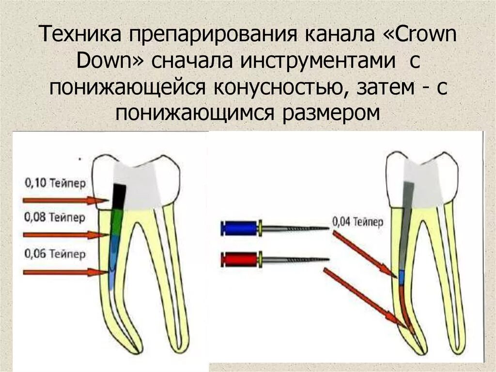 Crown down техника в эндодонтии