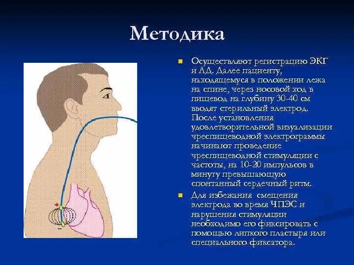 Через пищевод. Чреспищеводная электрическая стимуляция сердца. Чреспищеводное исследование сердца. Чреспищеводная предсердная электрическая стимуляция (ЧПЭС). Внутрипищеводная электрокардиография.