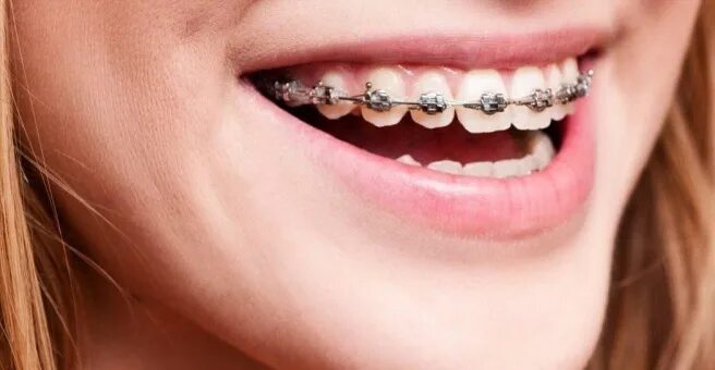 Как выглядят брекеты на детях Braces Orthodontics, Dental braces, Metal braces