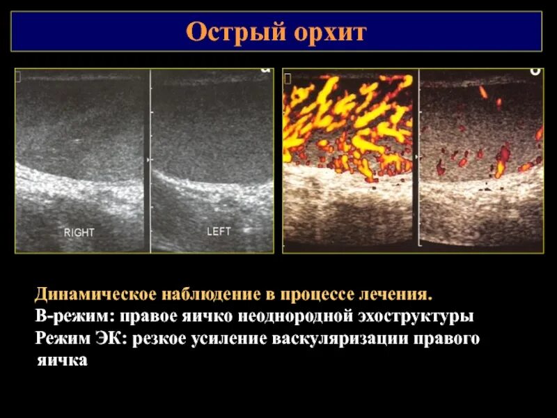 Хронический орхит УЗИ признаки. Острое воспаление яичек. Воспаление яичка лечение антибиотиками