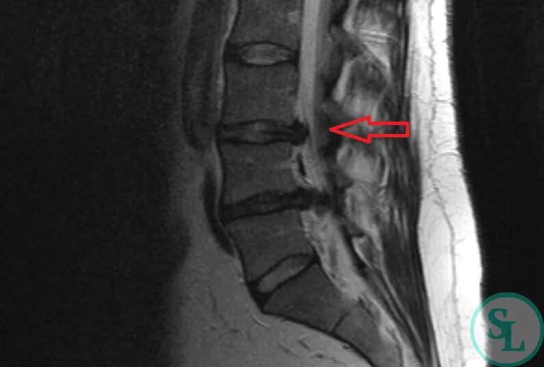 L4 l5 отдел позвоночника протрузия. Медиальная грыжа l4 l5. Диск l4-l5. Грыжа диска l5-s1. Грыжи дисков l4-l5.