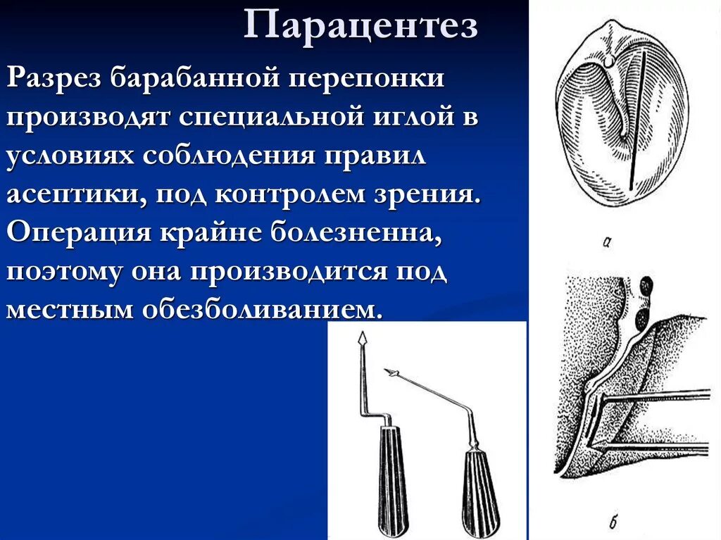 Парацентез барабанной перепонки это. Парацентез.барабанной.перепонки обезболивание.. Перфорация барабанной перепонки операция. Миринготомия барабанной перепонки. Тимпанотомия барабанной перепонки.