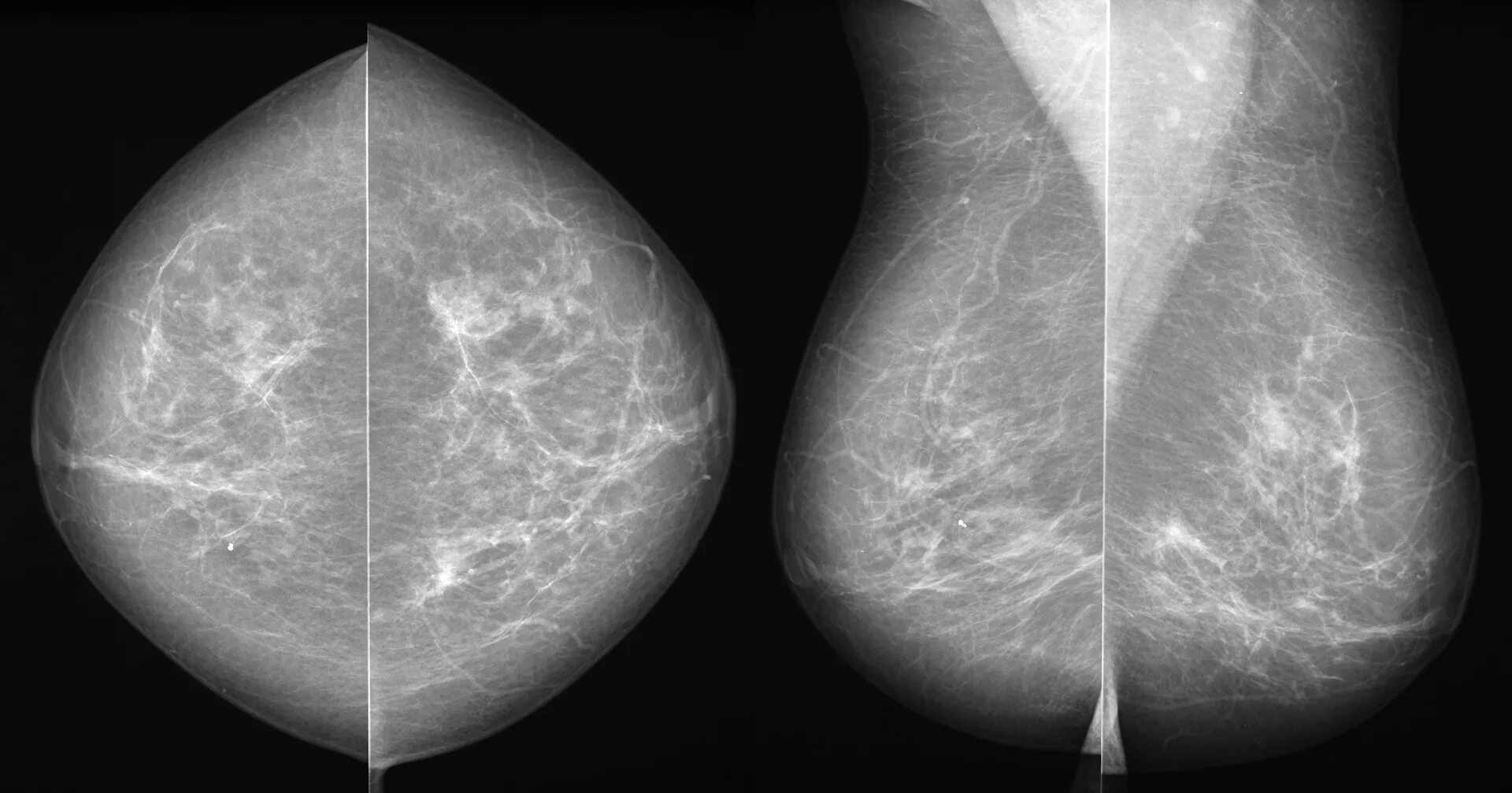 Маммография 2 молочных желез