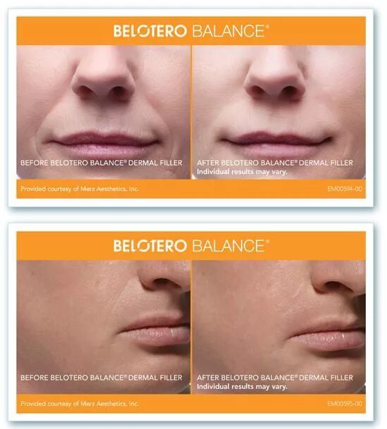 Belotero shape отзывы. Belotero Lips Shape, 0,6 мл. Белотеро Интенс 0.6 мл в губы. Губы 1мл Белотеро Интенс. Белотеро софт для губ.