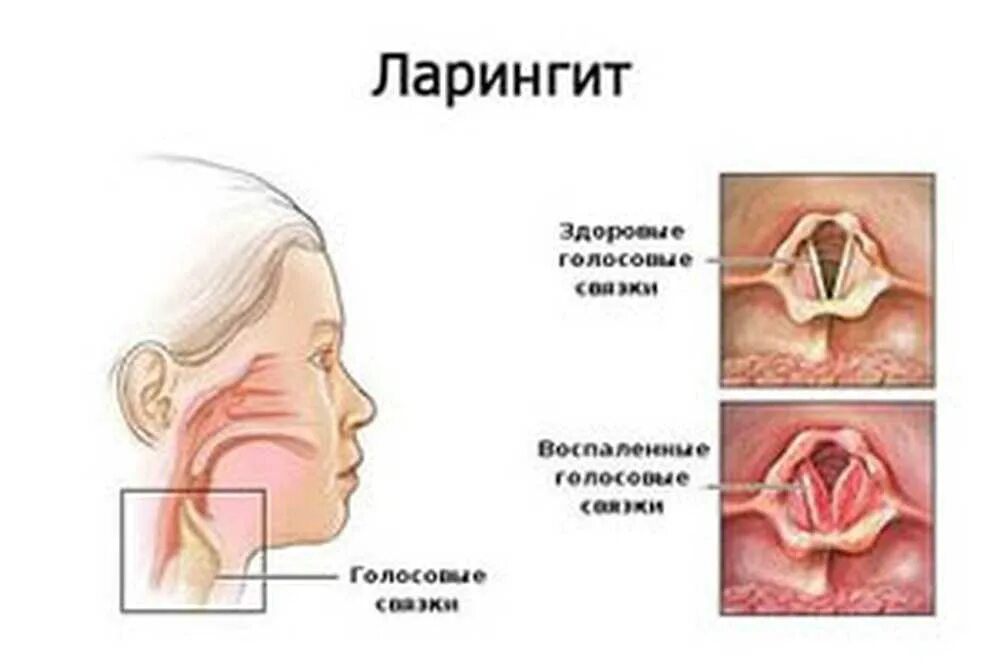 Ларингит сколько дней длится. Острый и хронический ларингит симптомы. острый катаральный ларингит профилактика. острый ларингит у детей симптомы. острый катаральный ларингит симптомы.