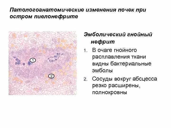 Абсцесс почки макропрепарат. Бактериальная эмболия почки микропрепарат описание. Абсцесс почки описание микропрепарата. Восходящий Гнойный нефрит микропрепарат.