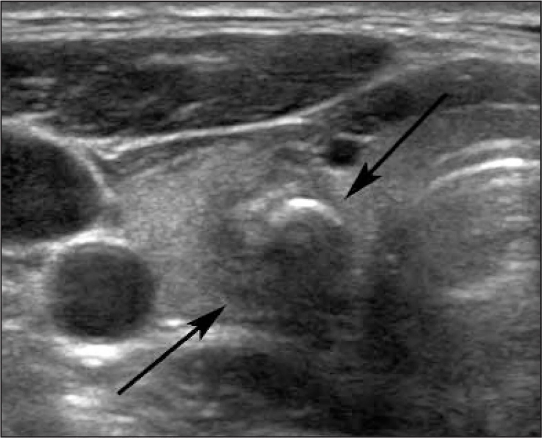 Гиперэхогенным округлым образованием. Гипоэхогенный узел щитовидной железы на УЗИ. Гипоэхогенные узлы на УЗИ щитовидной железы. Лимфатический узел щитовидной железы УЗИ. Изоэхогенное образование щитовидной железы УЗИ.