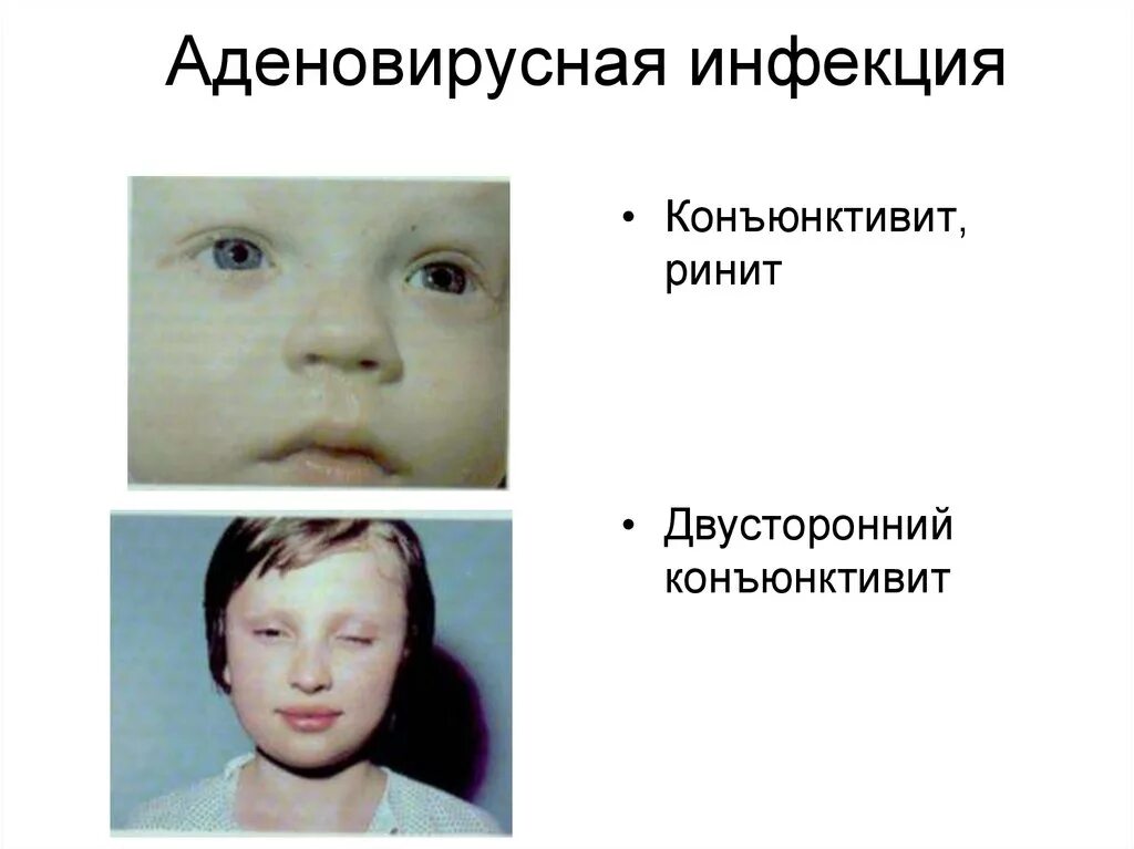 Инкубационный период аденовирусной инфекции. Аденовирусная инфекция. аденовирусная инфекция у детей симптомы. аденовирусная инфекция заражение. клиника аденовирусной инфекции кратко.