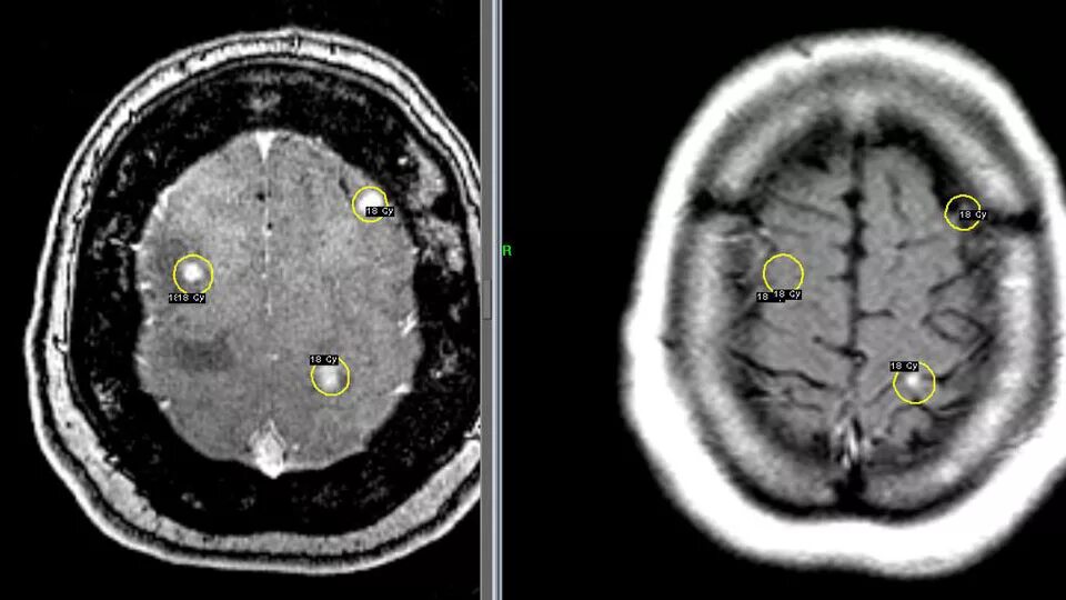 Лечение метастазов мозга. Метастазы меланомы в головной мозг кт. Метастазы головного мозга мрт. Опухоль головного мозга метастазы.
