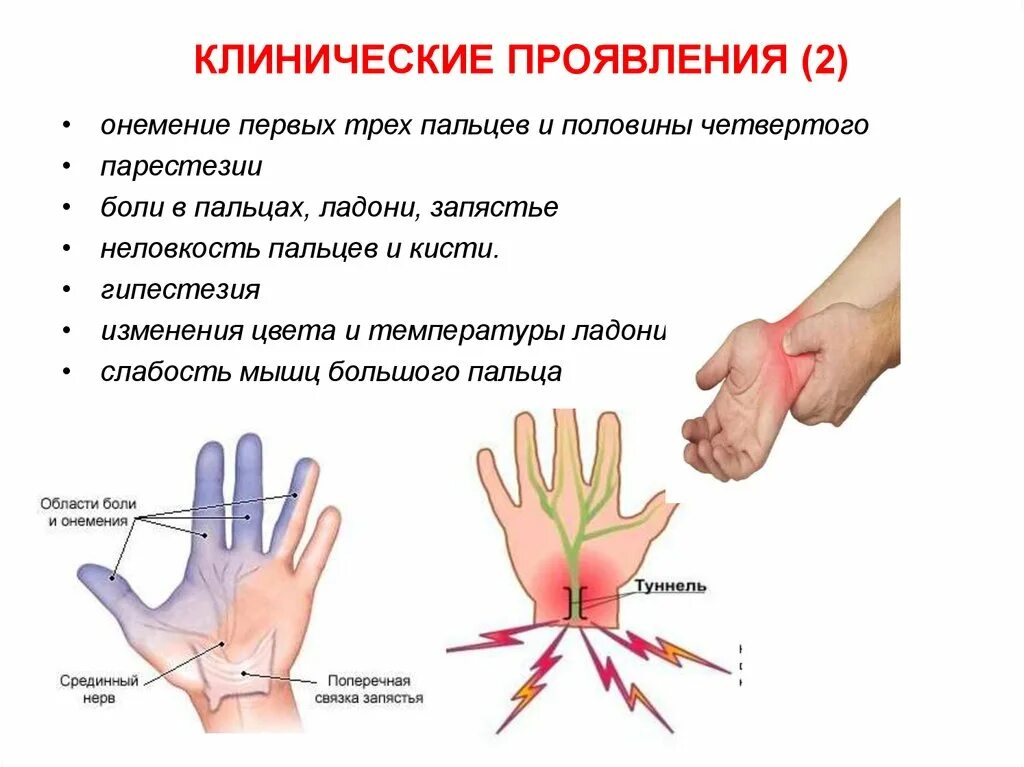 Почему немеют пальцы левой кисти. Туннельный синдром кисти руки симптомы. .Туннельный синдром запястья туннельный. Симптомы туннельного синдрома запястного канала. Туннельный синдром лучезапястного сустава.