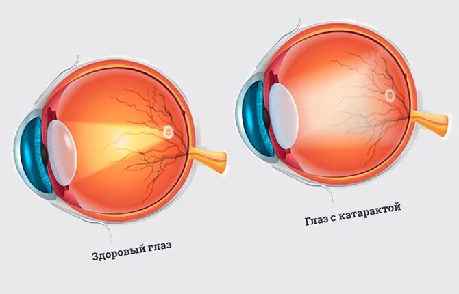 Чем отличается импортный хрусталик от отечественного. Чем отличается импортный хрусталик от отечественного
