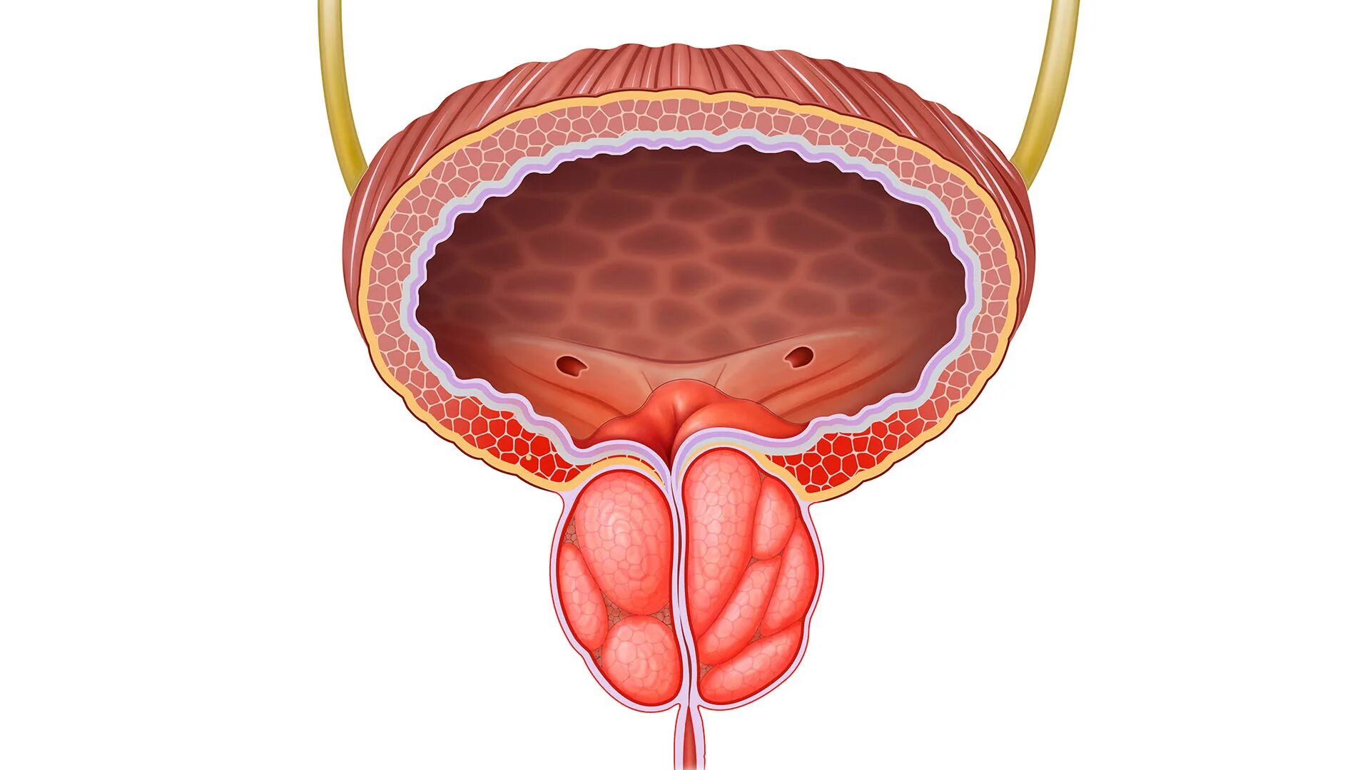 Хроническая простата аденома. Воспаление предстательной железы. Хронический простатит. Предстательная железа у женщин.