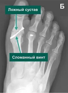 Межфаланговый артроз стопы