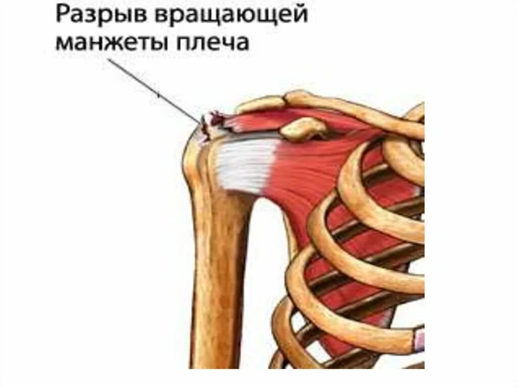 Повреждение вращательной