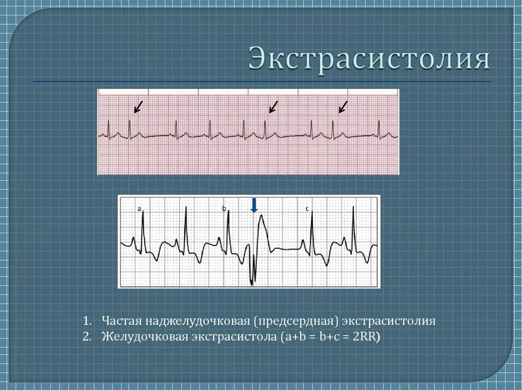 ЭКГ С наджелудочковой экстрасистолией. Суправентрикулярная экстрасистолия на ЭКГ. Наджелудочковые экстрасистолы на ЭКГ. Наджелудочковая экстрасистолия на ЭКГ. Экстрасистолы в минуту