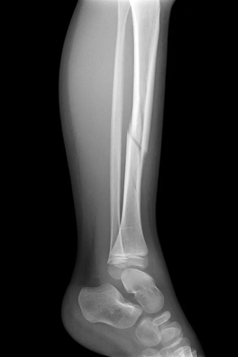 Рентгенография костей голени. Перелом ноги снимок рентген.