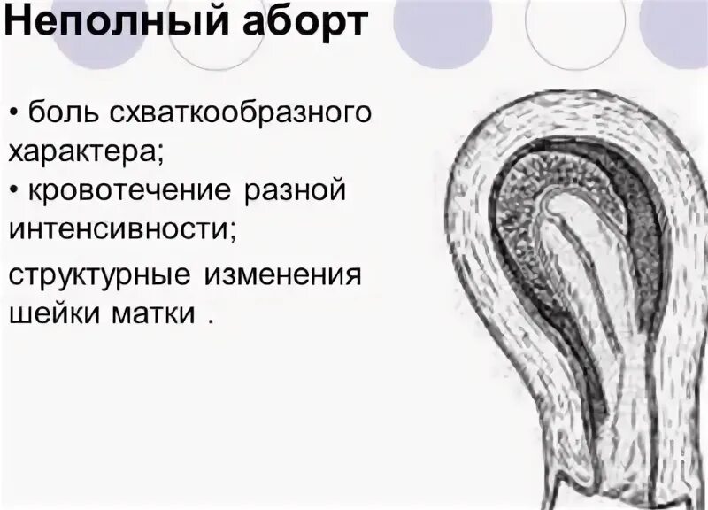 Неполный медикаментозный. Неполный самопроизвольный аборт. неполный медикаментозное прерывание. неполный маточный аборт.