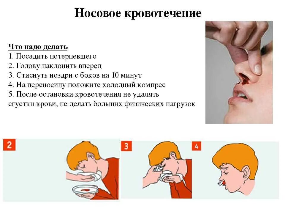 Острое носовое кровотечение. Остановить кровотечение из носа. При кровотечении из носа. Остановка кровотечения из носа. Как остоновитькрофь из носа.