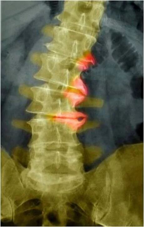 Спондилеза спондилоартроза поясничного отдела позвоночника. Деформирующий спондилез спондилоартроз. Диффузный спондилез. Остеофиты на рентгене шейного отдела. Остеофиты спондилез.