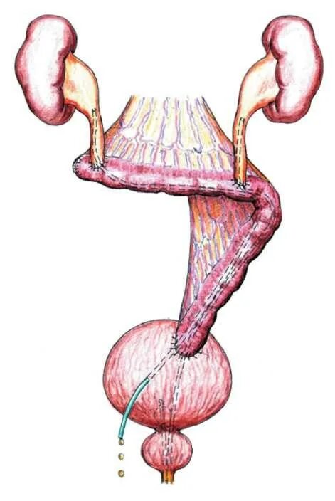 Пластика мочеточника кишкой. Кишечная пластика мочеточника. Замещение мочеточника. Пластика мочеточника тонкой кишкой. Обоих мочеточников