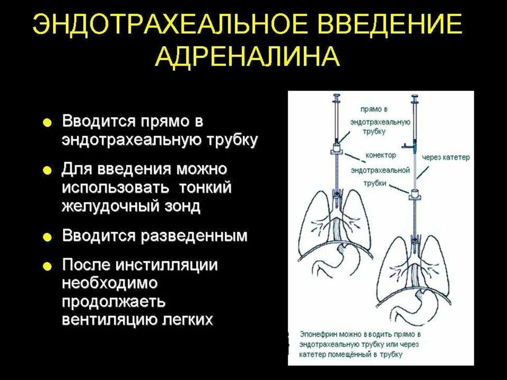 Эндотрахеальное Введение адреналина. Эндлтрахеальнон Введение. Введение в эндотрахеальная трубка адреналин. Эндотрахеальное Введение адреналина у детей. Звук адреналина