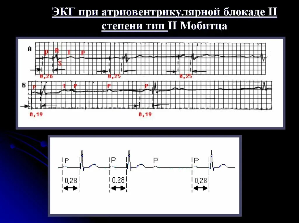 Атриовентрикулярная блокада 2. ЭКГ при АВ блокаде 2 степени. Атриовентрикулярная блокада 2 степени на ЭКГ. АВ блокада 2 степени Мобитц 1 критерии. АВ блокада 3 степени на ЭКГ.