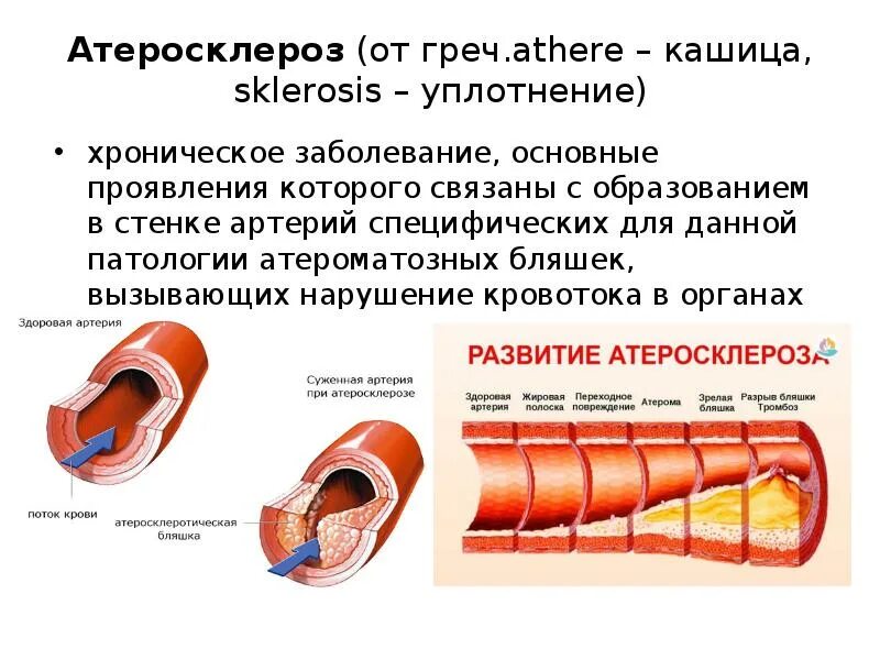 Распад сосудов. Уровень поражения стенки сосудов при атеросклеротической болезни. Развитию атеросклеротических поражений сосудов способствуют. Повреждение стенок сосудов, атеросклероз;. Причины формирования атеросклеротической бляшки.