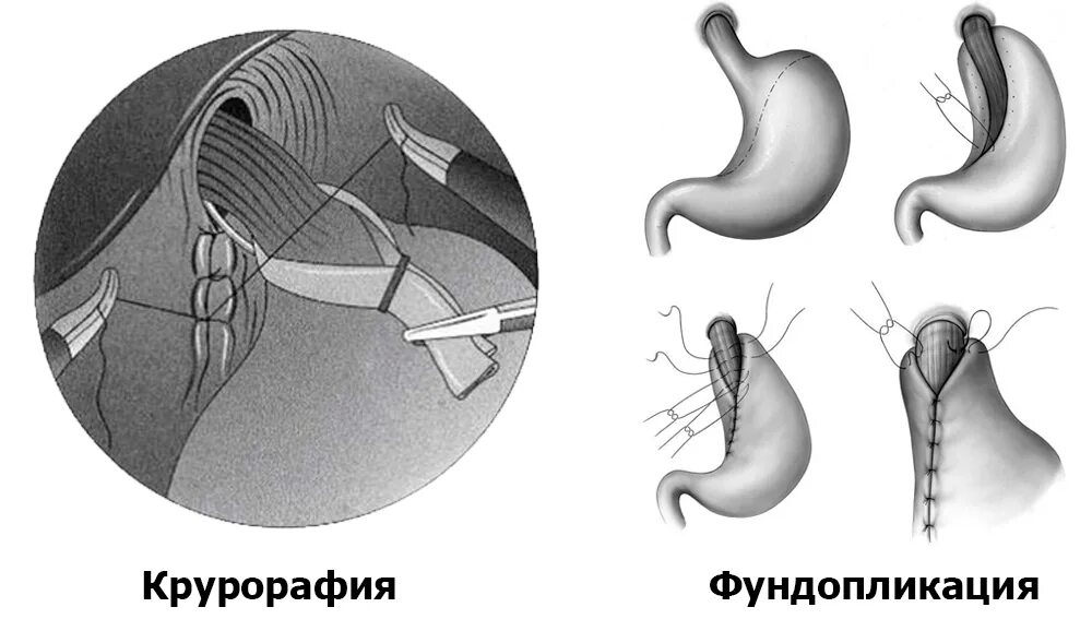 Грыжа пищеводного отверстия причины. Аксиально-хиатальная грыжа. Диафрагмальная грыжа пищевода. Аксиальная хиатальная грыжа. Хиатальная грыжа желудка что это.